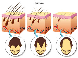 alopecia
